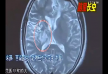 少女大脑皮层萎缩 医生从她脑子里捉出5cm长虫子