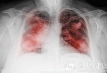 欧洲医学新发现：免疫细胞新发现有助于开发慢性肺炎疗法