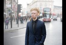 英白化病男孩受尽嘲笑 成功逆袭成时尚模特