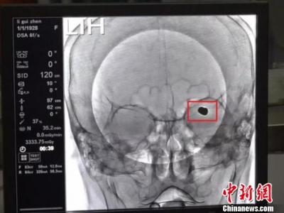 九旬老人脑部长“巨型”动脉瘤 医生拆除“不定时炸弹”