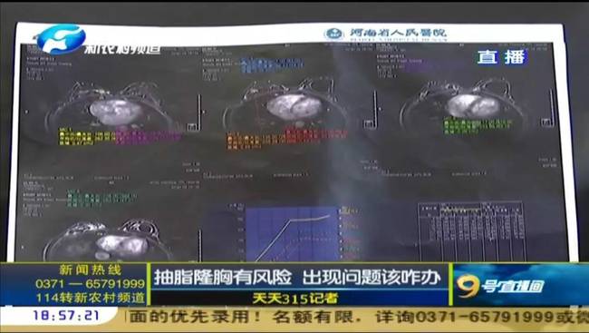 郑州曹乐医疗整形：抽脂隆胸不靠谱 整出问题沟通难