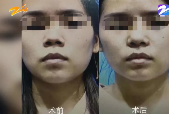 杭州甄美整形医院把人鼻子整歪了？医院：自己长歪了