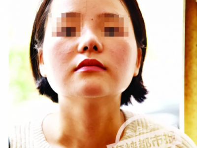 泉州东大整形医院被投诉：女子花4.4万整容 鼻子歪成这样