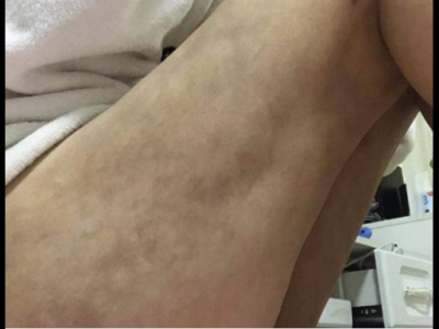 南昌亚太医疗美容医院抽脂手术后情况很糟糕 女子维权却被骂出来