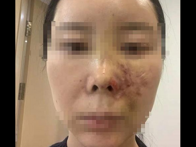 女子在沈阳美莱整形后面部青紫不敢见人 赔偿问题未能达成一致
