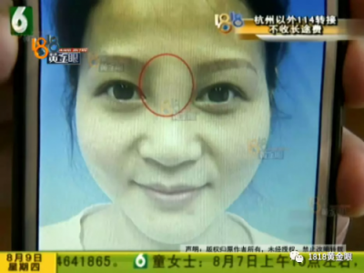 想要“柔美”结果宁波益宝医疗美容把她整像猪头？