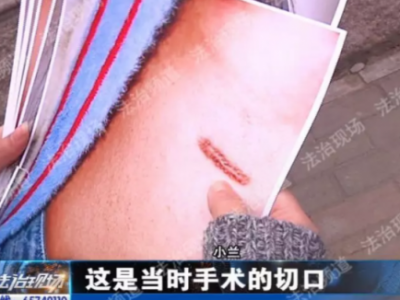 郑州新生医院隆鼻失败 假体往外透院方称没法解决