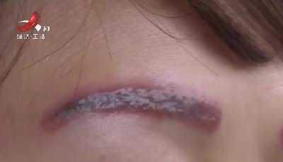 去南昌韩美美容医院激光洗眉后生不如死 洗完感觉自己像怪物