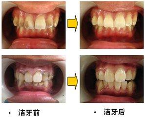 杭州美奥口腔怎么样？洗牙能去除烟渍吗