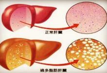 从脂肪肝到肝癌只需4步！做错这6件事，最容易得脂肪肝！