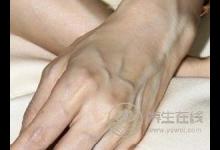 请问身上青筋多说明体内寒湿重吗