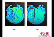 吃外卖、熬夜、少运动 小白领突发脑梗