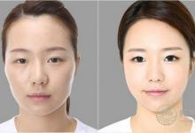 整容风水学 不可不知的整容禁忌