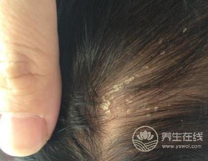 头皮屑多很尴尬？不妨多吃这几种食物