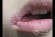 吃这些食物让你嘴巴不上火起泡！