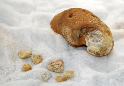 体内有结石的患者吃什么菜对身体最好