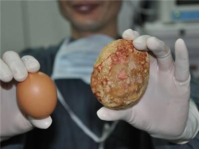 尿路结石是吃进的小石子？