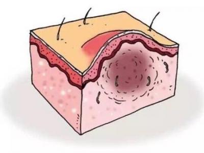 毛囊炎反复发作的原因以及治疗方法