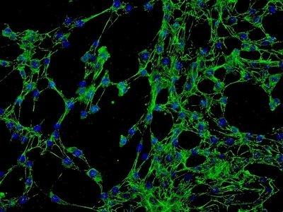 宫颈癌细胞学检查的特点及宫颈癌的预防