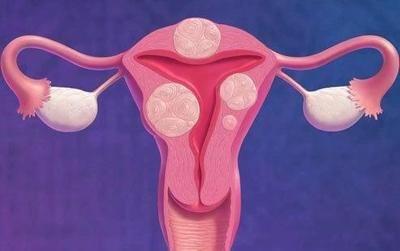 这七类女性是子宫肌瘤的高发人群