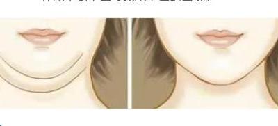 为什么会长双下巴的几种原因