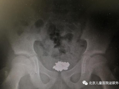 大夫，宝宝把东西塞进下面了！怎么办？