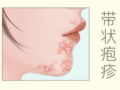 带状疱疹能吃羊肉吗