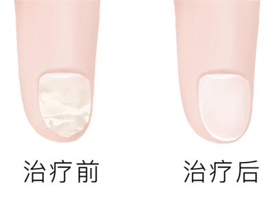治疗灰指甲哪家医院好
