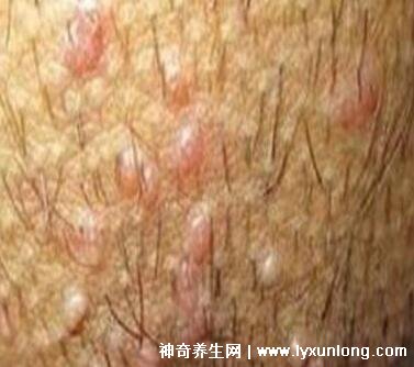 初期尖锐湿尤图症状图片男性，淡红色小疙瘩变大为菜花状疣体