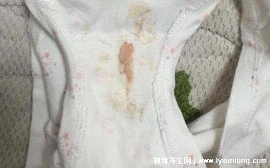 宫颈癌褐色分泌物图片，少量不规则出血伴随X交痛(腥臭分泌物)