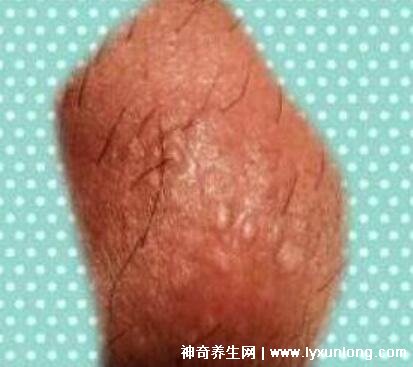 初期尖锐湿尤图症状图片男性，淡红色小疙瘩变大为菜花状疣体