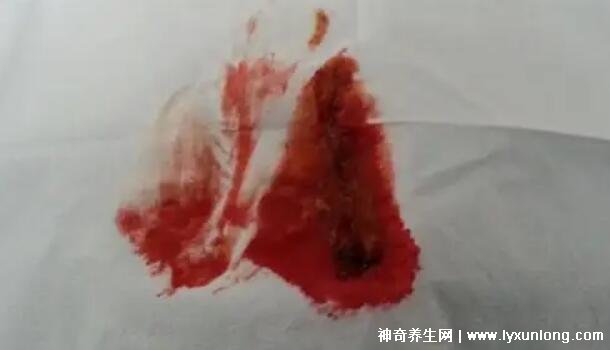 宫颈癌褐色分泌物图片，少量不规则出血伴随X交痛(腥臭分泌物)