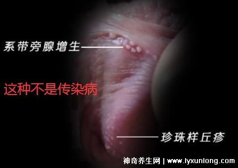 初期尖锐湿尤图症状图片男性，淡红色小疙瘩变大为菜花状疣体
