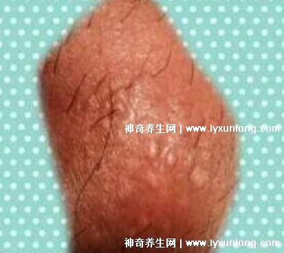男性早期图片尖湿锐疣长在哪，生zhi器甚至是口腔(菜花状疣体出血)