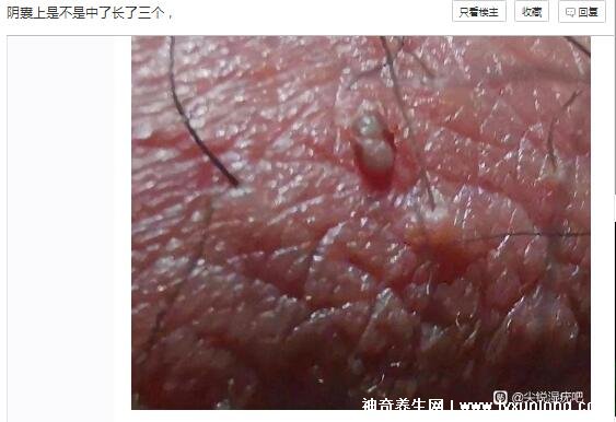 男性早期图片尖湿锐疣长在哪，生zhi器甚至是口腔(菜花状疣体出血)