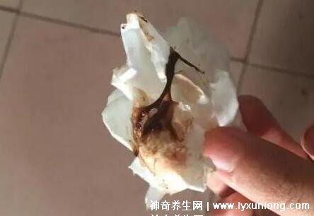宫颈癌褐色分泌物图片，少量不规则出血伴随X交痛(腥臭分泌物)