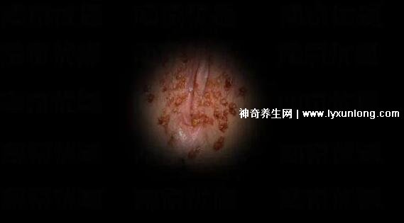 初期女士湿锐疣图片早期，口腔尖锐湿症状太吓人了(菜花样疣体)