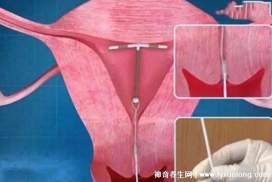 打一针不怀孕的针多少钱价格，69元避孕一个月(6款避孕针价格表)