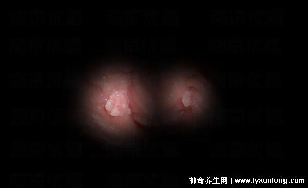 初期尖锐湿尤图症状图片男性，淡红色小疙瘩变大为菜花状疣体