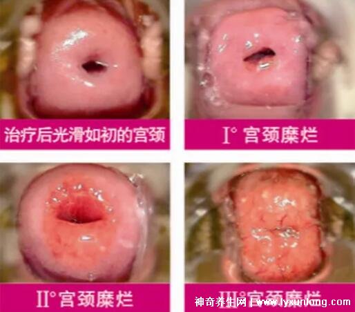宫颈癌褐色分泌物图片，少量不规则出血伴随X交痛(腥臭分泌物)