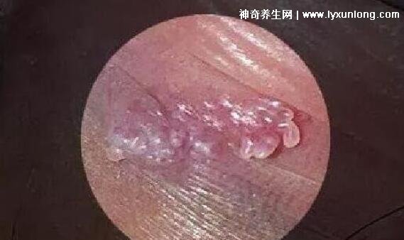 初期女士湿锐疣图片早期，口腔尖锐湿症状太吓人了(菜花样疣体)