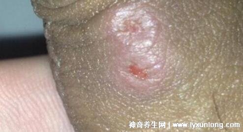 初期尖锐湿尤图症状图片男性，淡红色小疙瘩变大为菜花状疣体