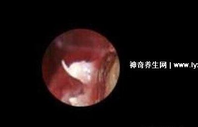 初期女士湿锐疣图片早期，口腔尖锐湿症状太吓人了(菜花样疣体)