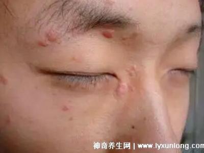 男性疣是什么样子图片，尖锐湿疣/扁平疣/丝状疣发病部位不同