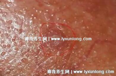 男性早期图片尖湿锐疣长在哪，生zhi器甚至是口腔(菜花状疣体出血)
