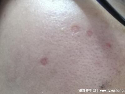 千万不要激光点痣后悔一辈子，可导致恶性黑色素瘤(共3个危害)