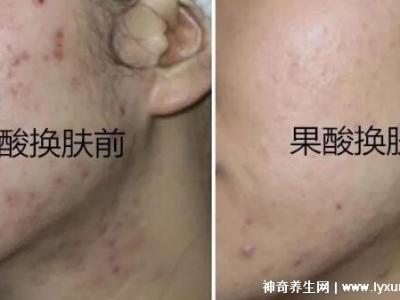 果酸换肤多少钱一次，1000-3000元不等(细致毛孔/淡化痘印)