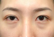  为什么会出现眼袋？怎样有效去眼袋？