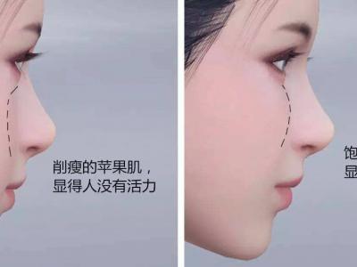 为什么苹果肌填充之后 脸部显着不自然？