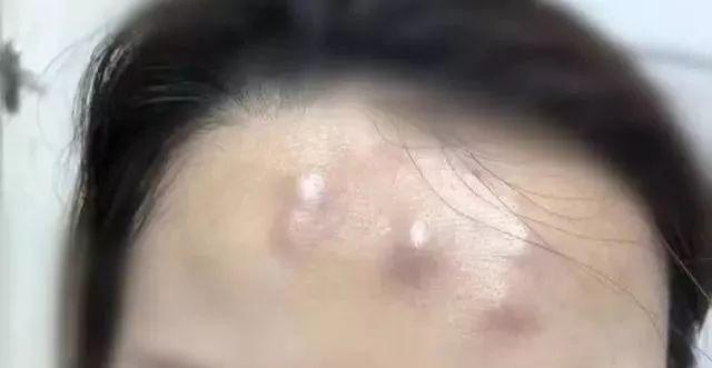 女子注射去皱 额头竟冒出5个“犄角”